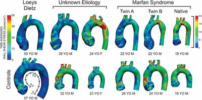 A Pilot Study Characterizing Flow Patterns in the Thoracic Aorta of Patients With Connective Tissue Disease: Comparison to Age- and Gender-Matched Controls via Fluid Structure Interaction